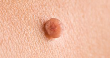 skin tag on hand