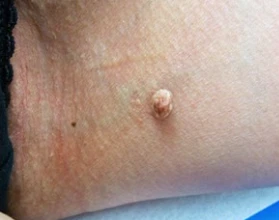 skin tag on leg