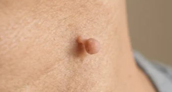 skin tag on neck
