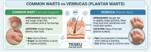 warts and verruca