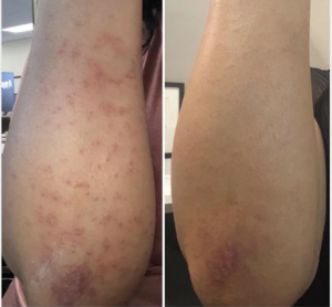 Click to view full screen cures my arm fungus