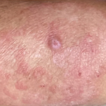 antifungal