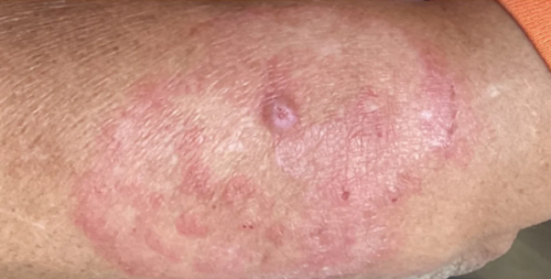 Click to view full screen antifungal