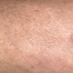 antifungal