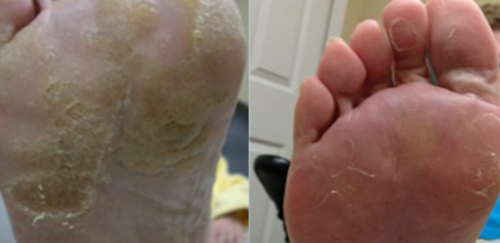 Click to view full screen athlete's foot
