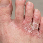 athlete's foot