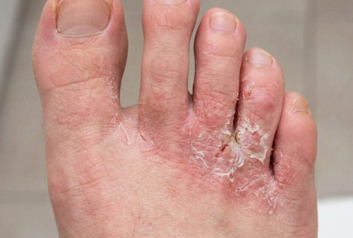 Click to view full screen athlete's foot