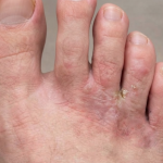TESEU Antifungal Athlete’s Foot Cream, Tea Tree Oil Herbal Relief photo review