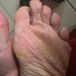 Antifungal Athlete’s Foot Cream