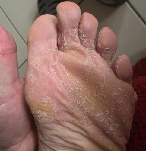 Click to view full screen Antifungal Athlete’s Foot Cream