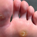 wart
