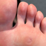 wart