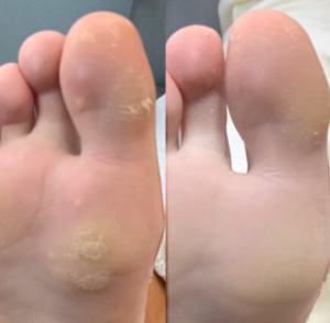Zum Vollbildmodus wechseln skin tag