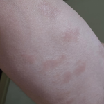 Antifungal Athlete’s Foot Cream