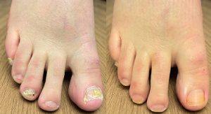 Click to view full screen TESEU Fungal Nail Treatment