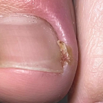 TESEU Fungal Nail Treatment