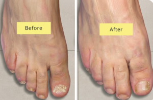Click to view full screen Fungal Nail Treatment