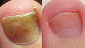 Click to view full screen TESEU Fungal Nail Treatment