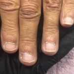 Fungal Nail Treatment for Fungal Toenails