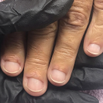 Fungal Nail Treatment for Fungal Toenails