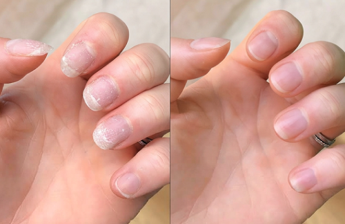 Click to view full screen Fungal Nail Treatment for Fungal Toenails
