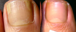 Click to view full screen Fungal Nail Treatment