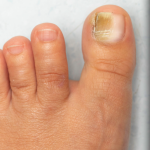 Fungal Nail Treatment