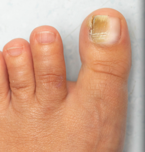 Click to view full screen Fungal Nail Treatment