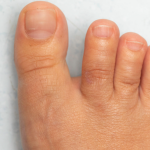 Fungal Nail Treatment