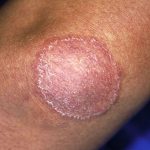 ringworm