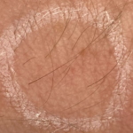 ringworm