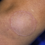 TESEU Jock Itch Antifungal Cream, Gentle Herbal Moisturizer photo review