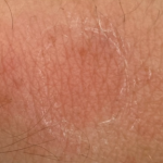 ringworm
