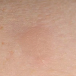 TESEU Jock Itch Antifungal Cream, Gentle Herbal Moisturizer photo review