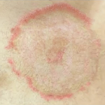 ringworm