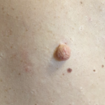 wart removal