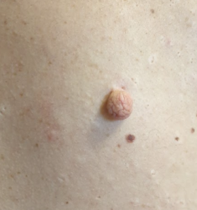 Click to view full screen wart removal