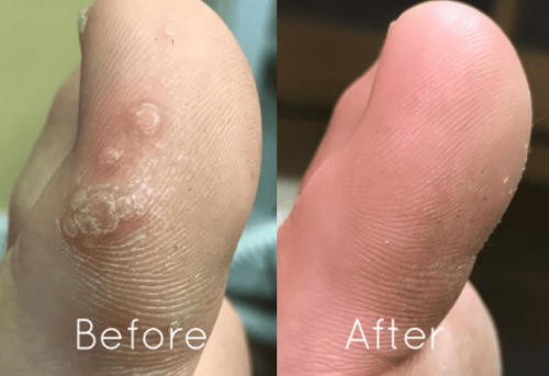 Click to view full screen Gentle Wart Remover