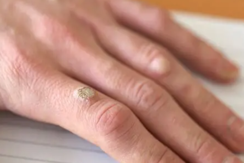 Click to view full screen wart on finger