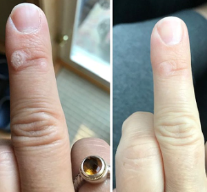 Click to view full screen wart pen
