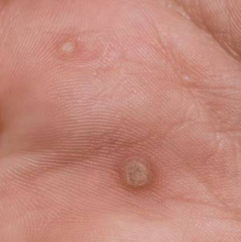 Click to view full screen wart on hand