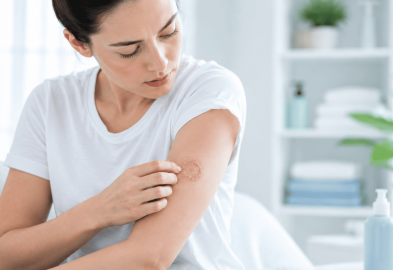 ringworm infections