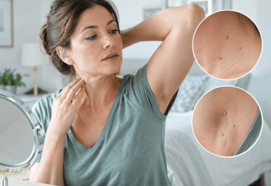 skin tag