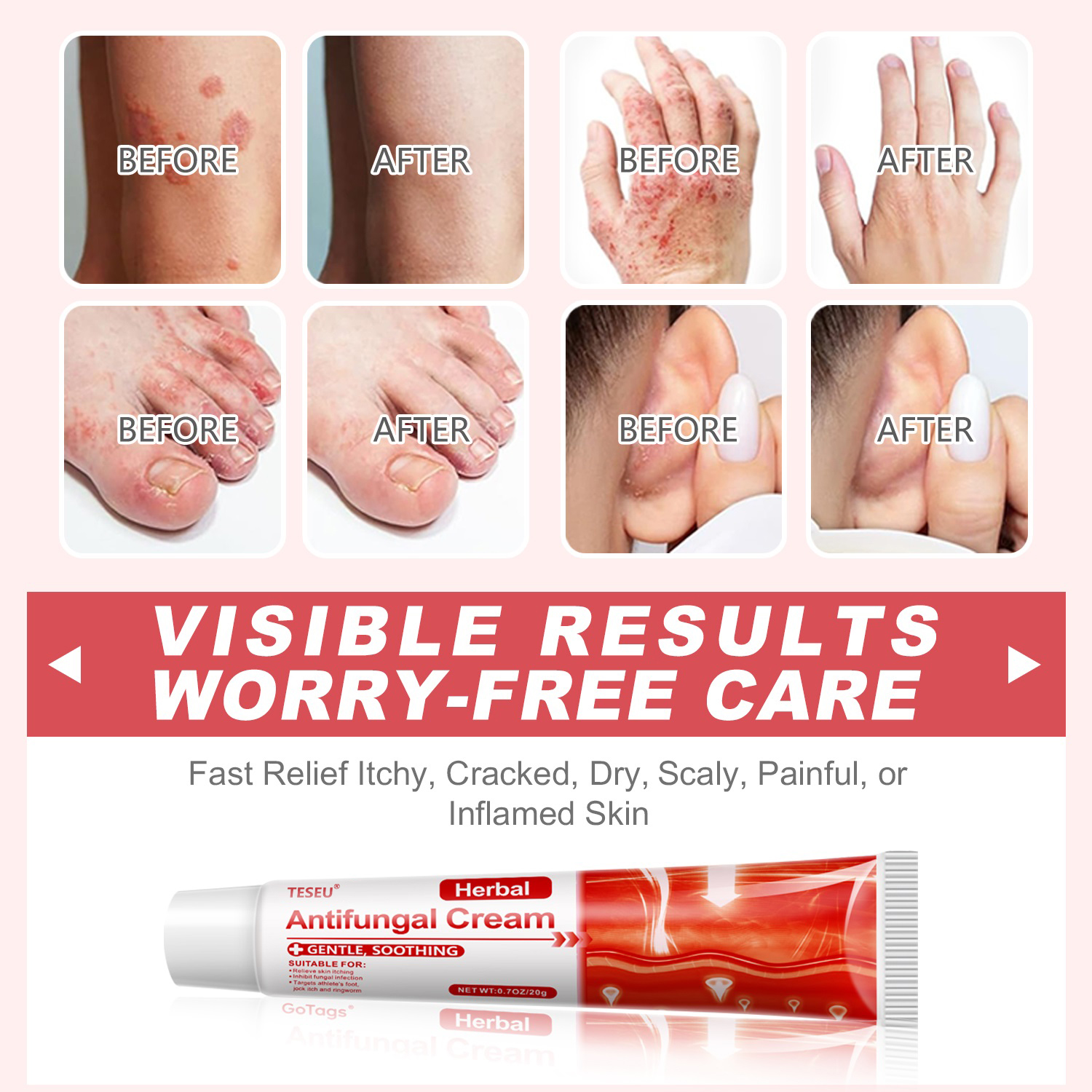 How do you distinguish between dry skin peeling and active athlete's foot?