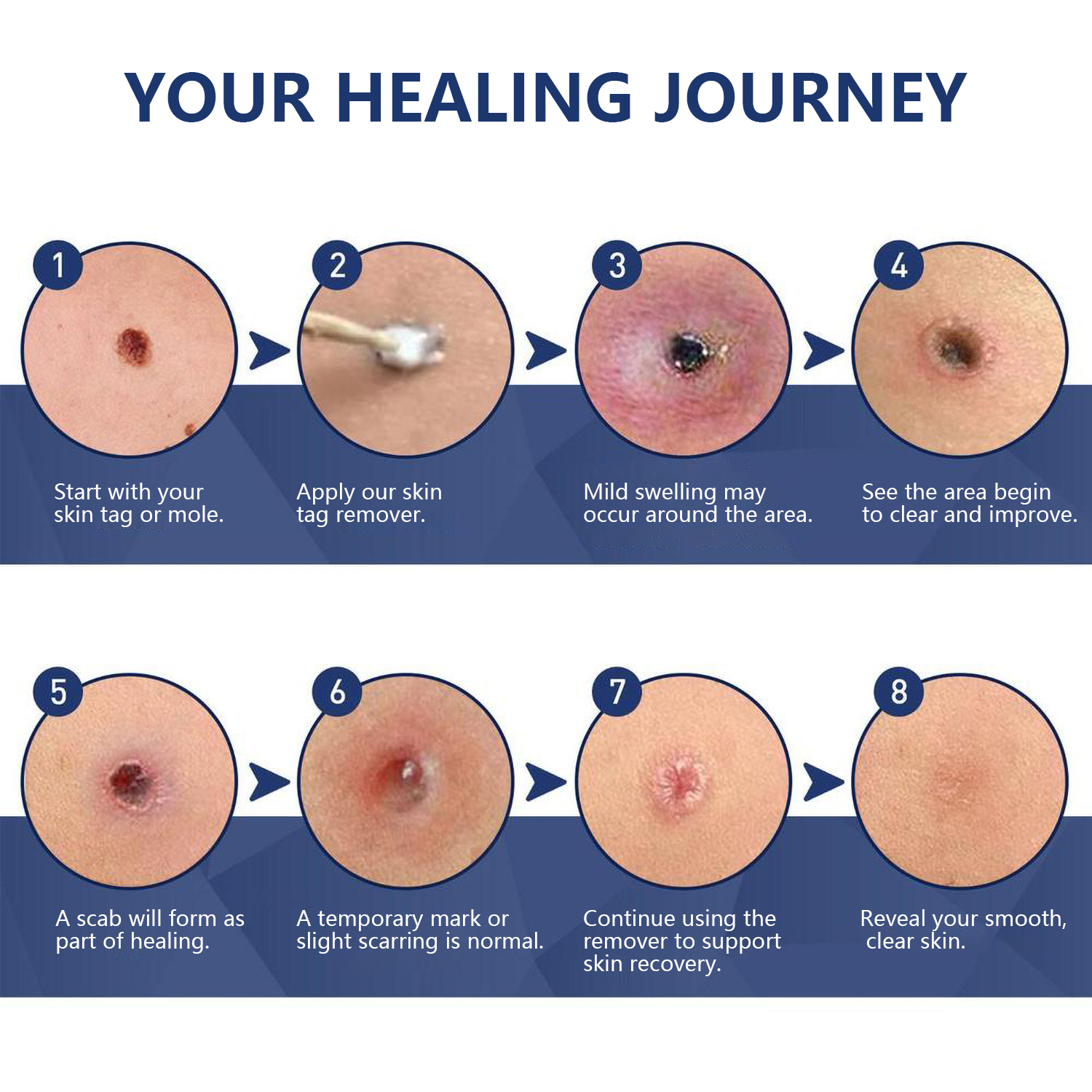 How does a gentle plant-based formula painlessly remove stubborn skin tags?