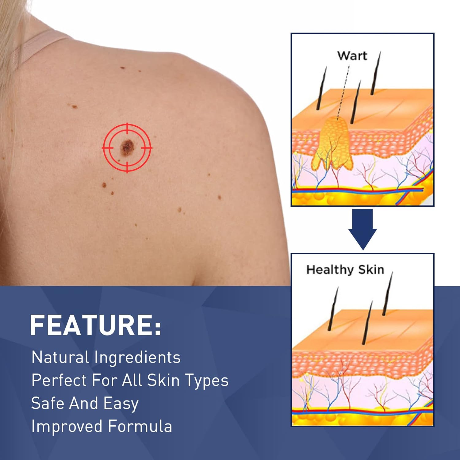 How do you safely protect the healthy skin around your treated wart?