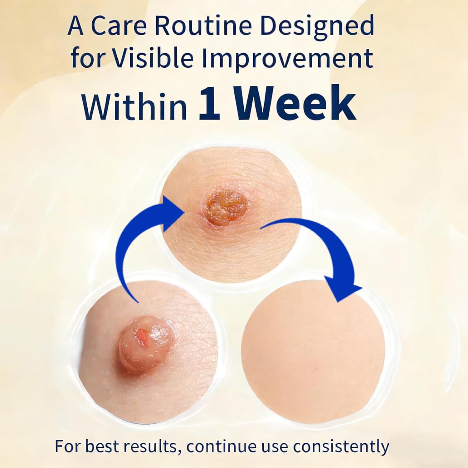 How can you manage mild tingling sensations during the wart removal process?
